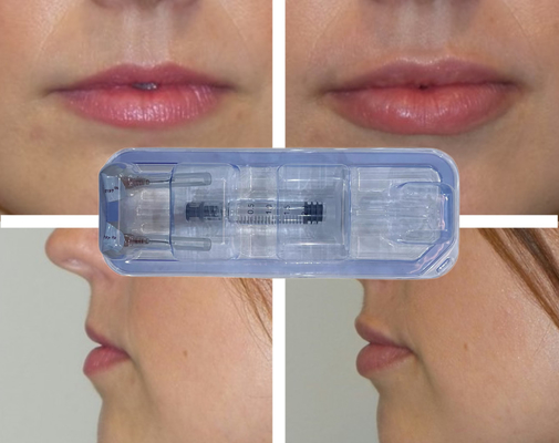 CE حقن الحمض الهيالوروني المتقاطع حشو شفاه الحقن 24mg/ml