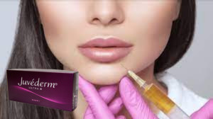 Juvederm Ultra 3 حقن حامض جلدي حمض الهيالورونيك حقن الوجه 2*1ml