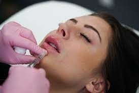 GMP Juvederm Ultra 3 HA حشو جلدي للشفاه Juvederm Vollure